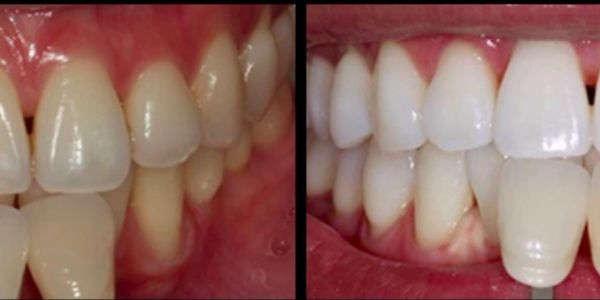 Close-up of teeth before and after treatment.