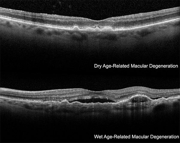 The OCT scan can reveal damage to the retina not visible during a normal retinal examination.