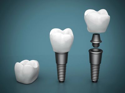 montrose teeth implants