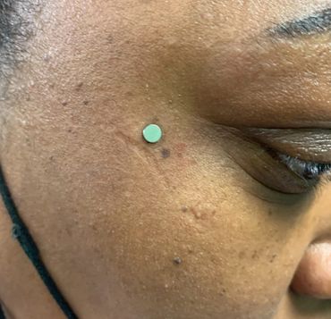 Fresh cheek dermal piercing featuring a sleek silver flat top.