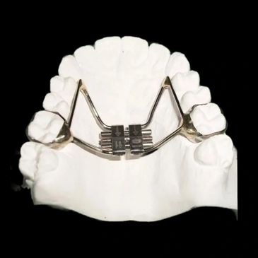 Orthodontic device on dental model for palate expansion.