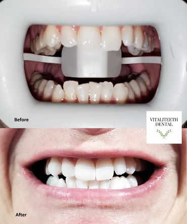 Before and After Philips Zoom At-Home Teeth Whitening with Monica Cordova of VitaliTeeth Dental