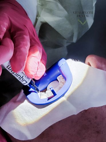 Protecting the gums closeup on man during Philips Zoom At-Home teeth whitening, VitaliTeeth Dental