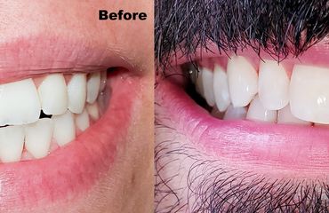 Before and After Philips Zoom At-Home Teeth Whitening by Monica Cordova of VitaliTeeth Dental