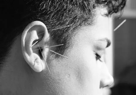 acupuncture needles in ear and forehead on male
