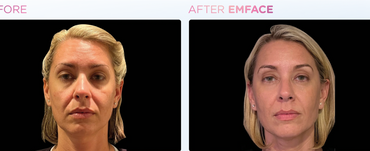Before and After 4 Sessions of EmFace