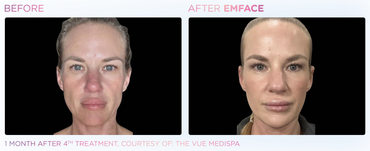 Before and After 4 Sessions of EmFace