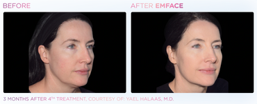 Before and After 4 Sessions with EmFace