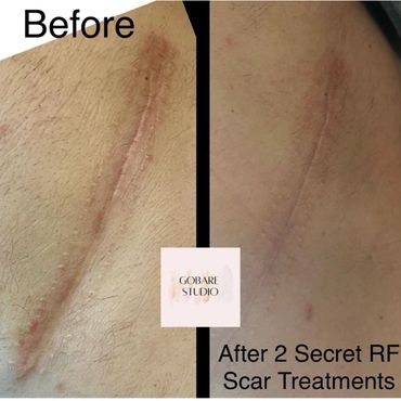 Scar Treatment scar revision