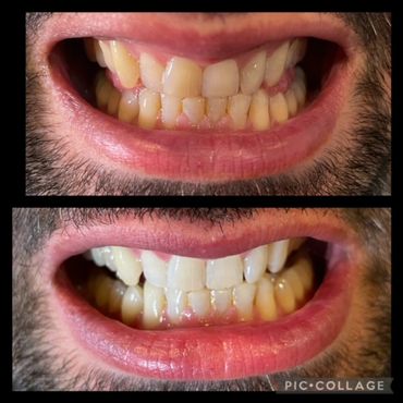 teeth whitening sunna smile sensitive teeth safe zoom whitening