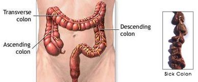 Healthy & Unhealthy Colon