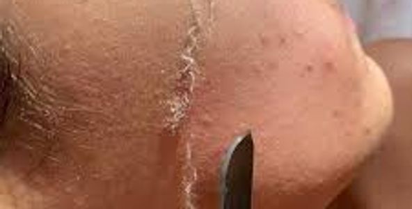 Dermaplaining to remove vellus hair ( peach fuzz ) to expose smoother skin for product and makeup