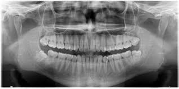 Panoramic Xray Machine