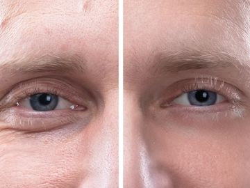 Radiofrequency microneedling before and after photo. Services offered at A Beauty By
Design studio