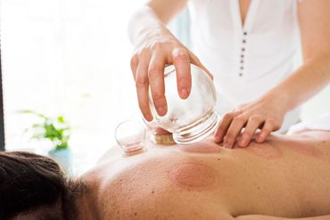 Patient receiving cupping for back pain.