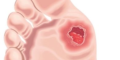 Foot ulcers are often caused by diabetic neuropathy or vascular disease. Any common foot problems in
