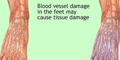 Uncontrolled diabetes can damage your nerves. If you have damaged nerves in your legs and feet, you
