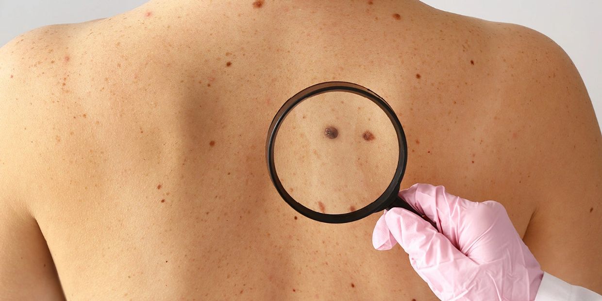 MELANOMA EARLY DETECTION | SKLIP