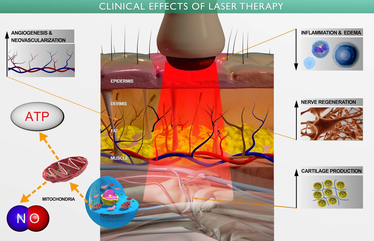 Photomedicine (laser) energy penetrates deeply to heal injured tissues and reduce pain