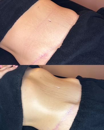 Before and after photos showing scar healing on a person's lower abdomen.
