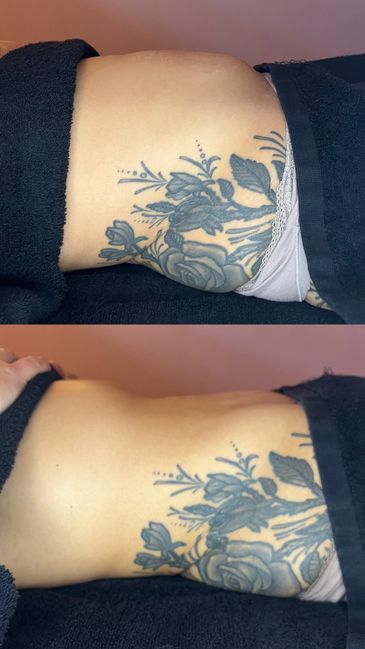 Before and after photo of a torso showing a floral tattoo and reduced belly size.