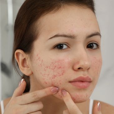 A woamn suffering from acne