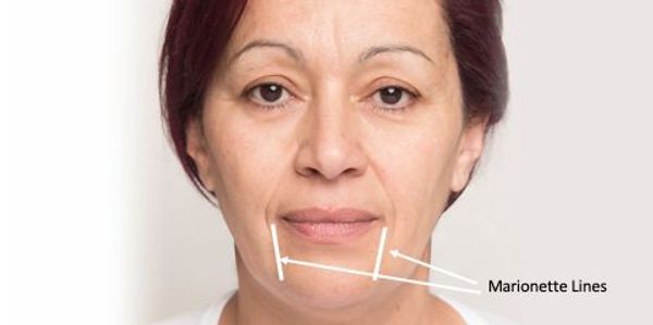 Surrey Botox® Clinic, by Dr. Ward. Botox®, Juvéderm® Fillers, CoolSculpting®, SkinMedica®, SkinVive™