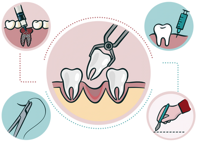 Tooth extraction. Local anesthesia. Bone graft. Surgical incision and suture.