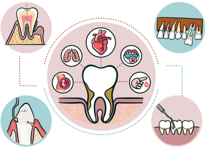 Bone loss and loose teeth. Dental cleaning. Relationships between gum disease and overall health.