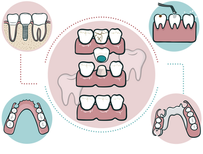 Dental implant. Dental crown. Removable dentures. Dental filling.
