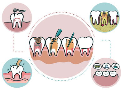 Root canal therapy. Tooth sensitivity to acid, cold, and hot. Tooth infection due to decay.