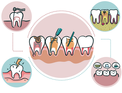 Root canal therapy. Tooth sensitivity to acid, cold, and hot. Tooth infection due to decay.