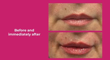 lip booster , bacio , hydration, rejuvination