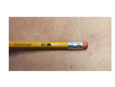 Full endoscopic spine surgery incision comparable with a number 2 pencil