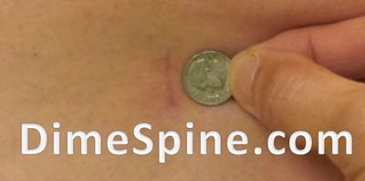 Single Dime Sized Incision TLIF