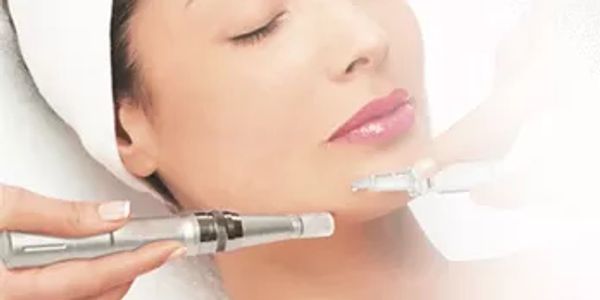 Microneedling in altamonte springs. Microneedling in Orlando. Best place for microneedling