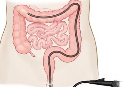 Click to see information on Colonoscopy