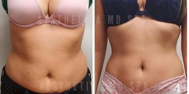 Before and After Image of a Woman who did Aesthetica MD Cypress Instaslim Program