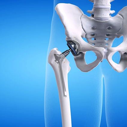 Post joint replacements rehabilitation provide returning to active lifestyle and goals sooner.