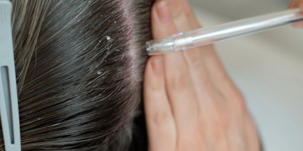 scalp health
scalp conditions
dandruff
eczema
seborrheic dermatitis 
psoriasis