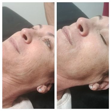 Before and After Geneo Anti Aging  Facial 