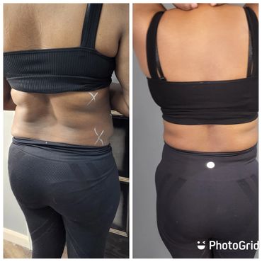 Before first CryoSlimming  Treatment and 2 weeks after first treatment 