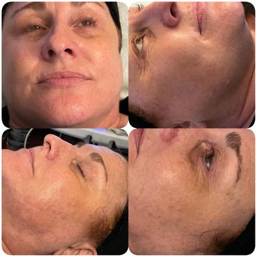 After and Before  Geneo Hydration Facial