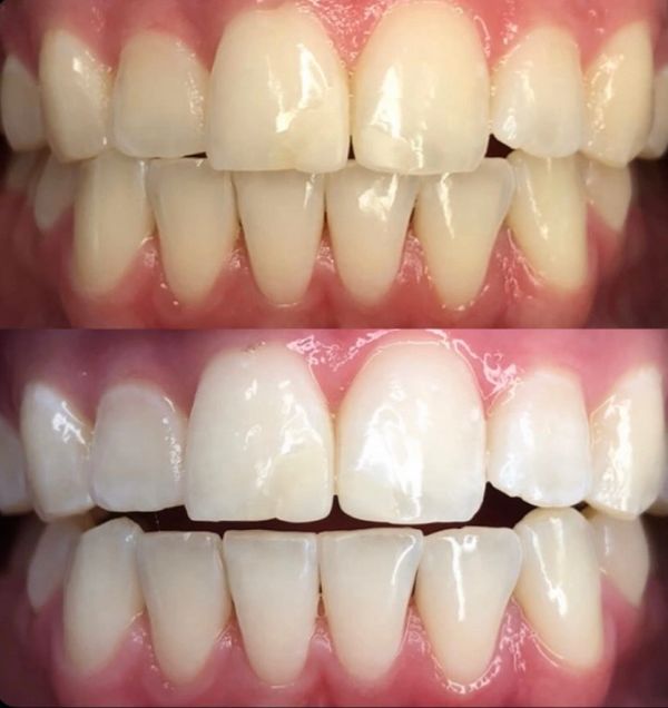 Close-up of teeth before and after whitening treatment.