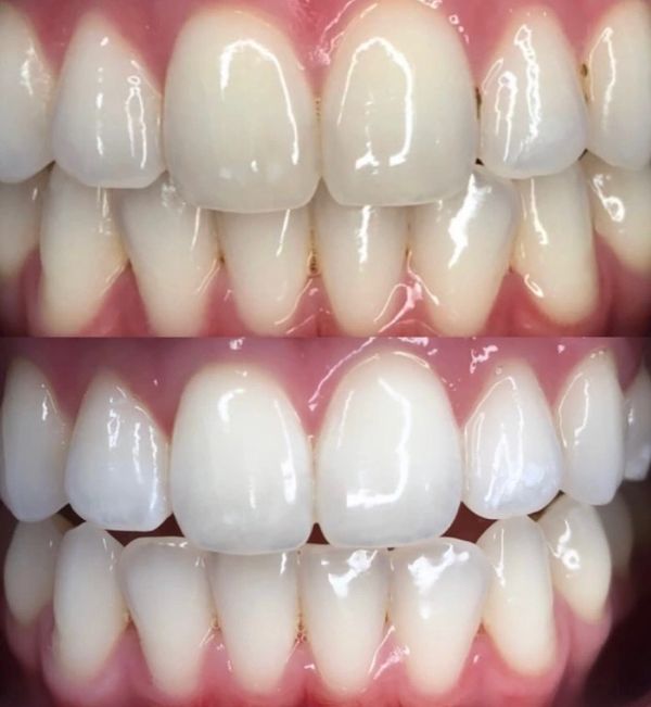 Close-up comparison of teeth before and after whitening treatment.