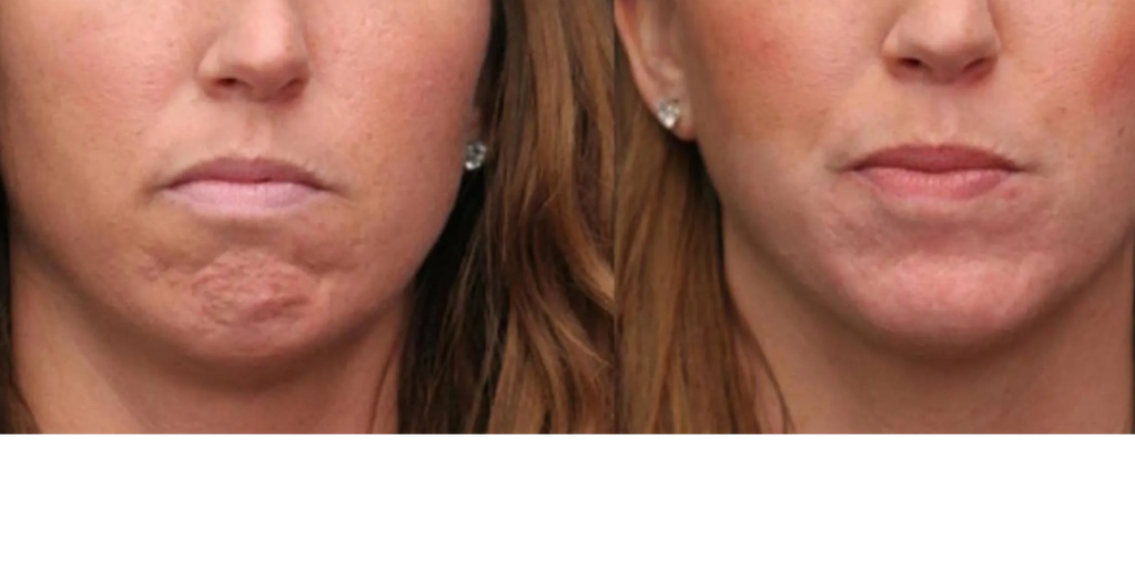 CHIN BOTOX