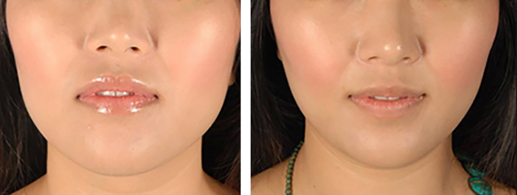 MASSETER BOTOX