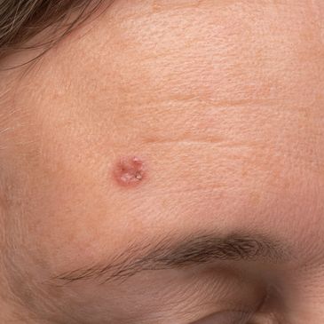 Close-up of a skin lesion on a person's forehead above the eyebrow.