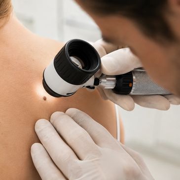 Dermatologist examining a mole on a patient's back with a dermatoscope.