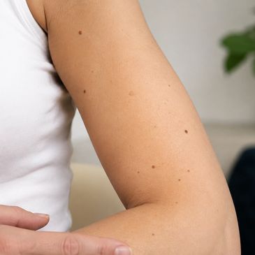 Close-up of a person's arm showing several small moles.